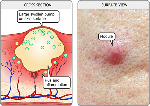 Acne illustration