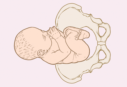 Breech flexed illustration