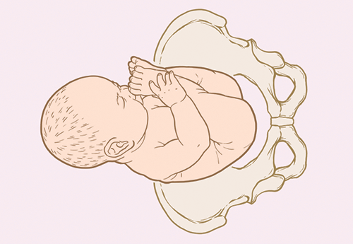 Breech extended or frank illustration