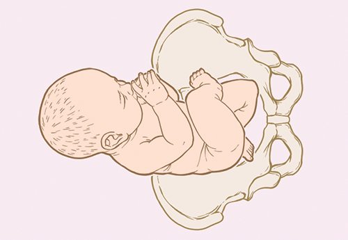 Breech knee illustration