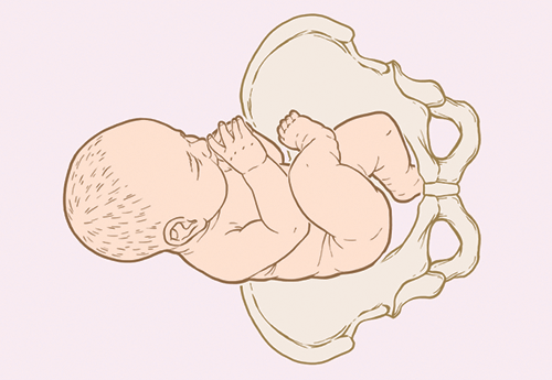 Breech footling illustration