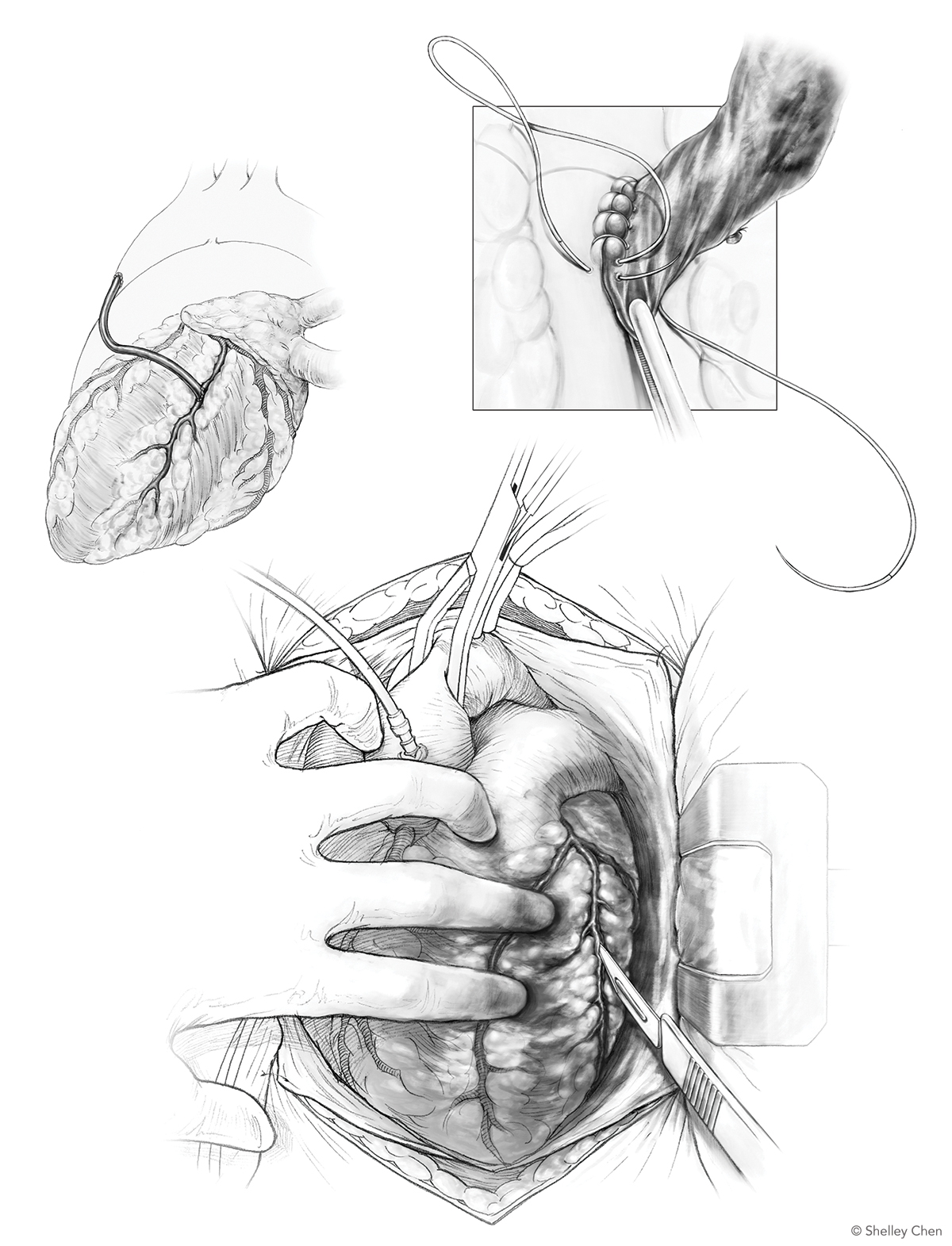 Coronary bypass illustration
