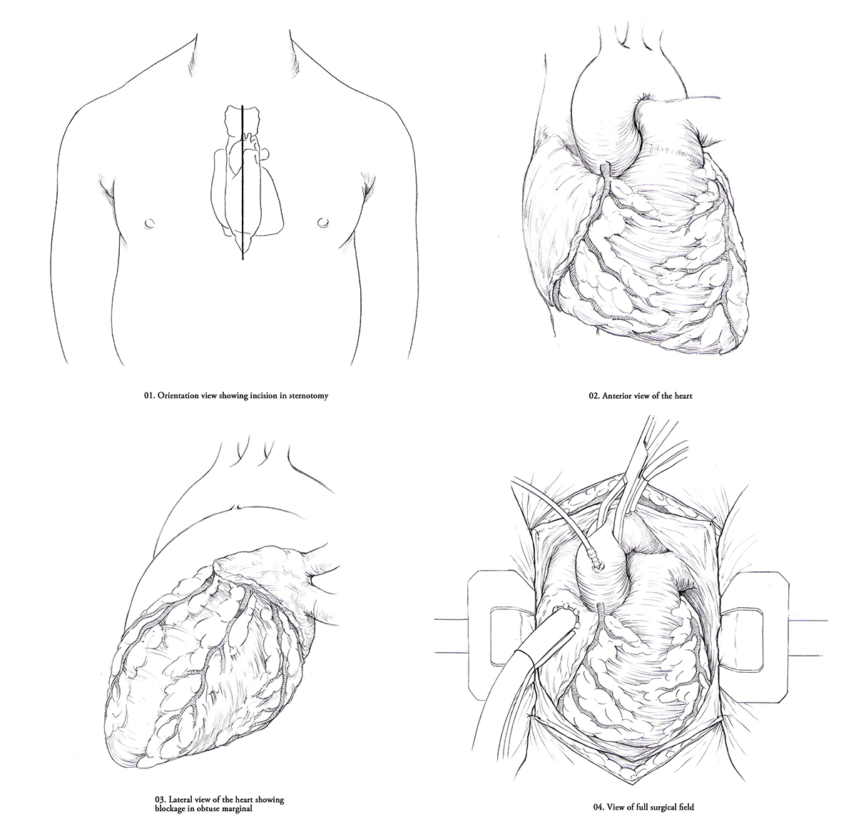 Coronary bypass sketches