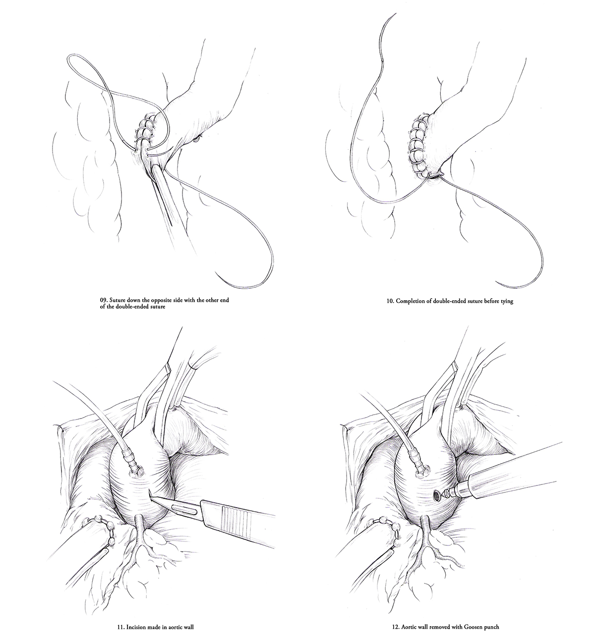 Coronary bypass sketches
