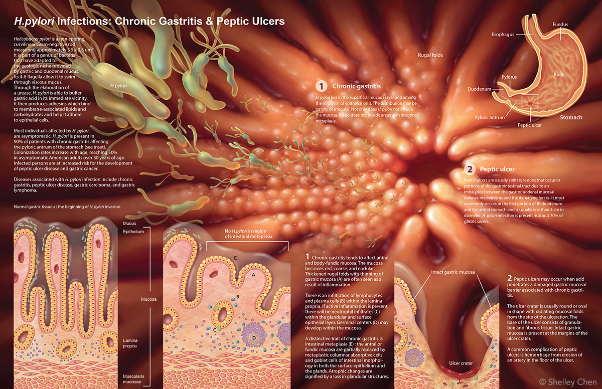 H.pylori illustration