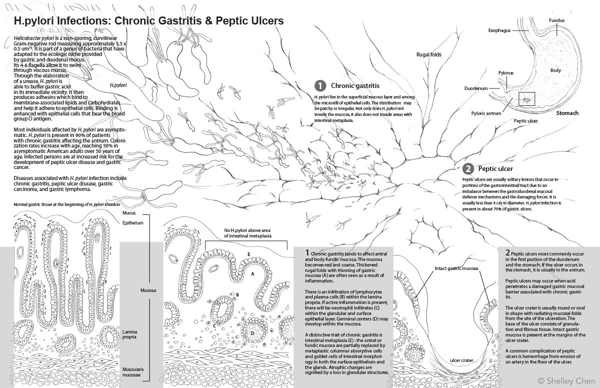 H.pylori sketch