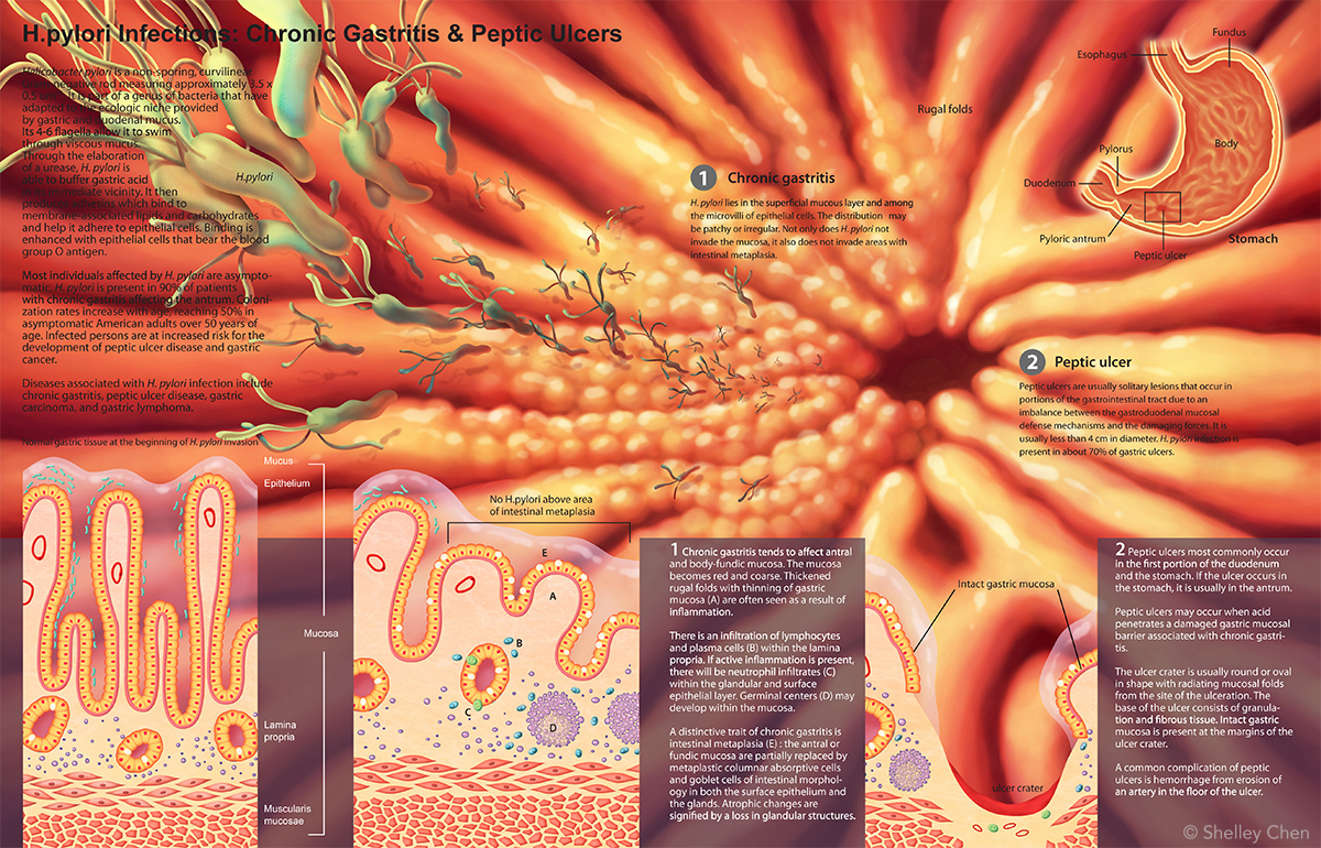 H.pylori work in progress